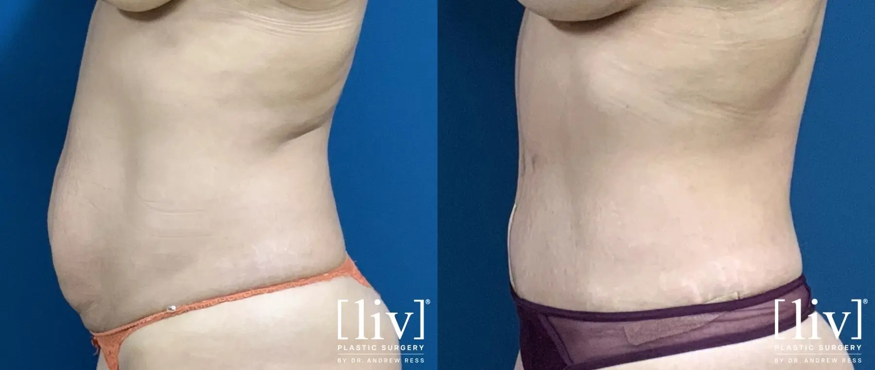 Lipoabdominoplasty - Before and After 3