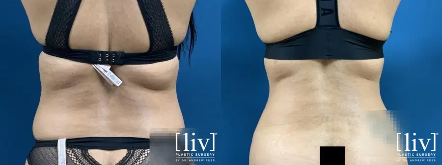 Abdominoplasty: Patient 3 - Before and After 4