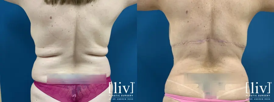 Back Lift: Patient 1 - Before and After 1