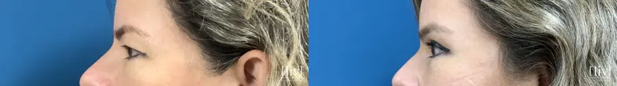 Upper Blepharoplasty - Before and After 3