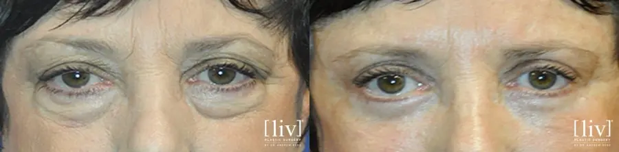 Blepharoplasty: Patient 3 - Before and After 1