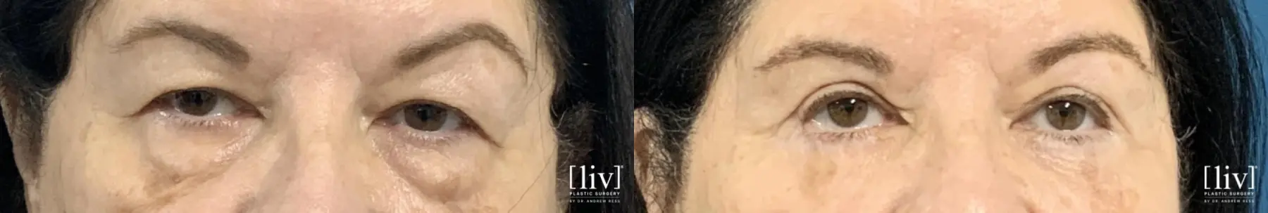 Upper and Lower Blepharoplasty  - Before and After 1