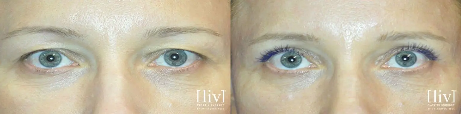 Upper Blepharoplasty - Before and After 1