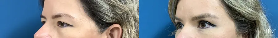 Upper Blepharoplasty - Before and After 2