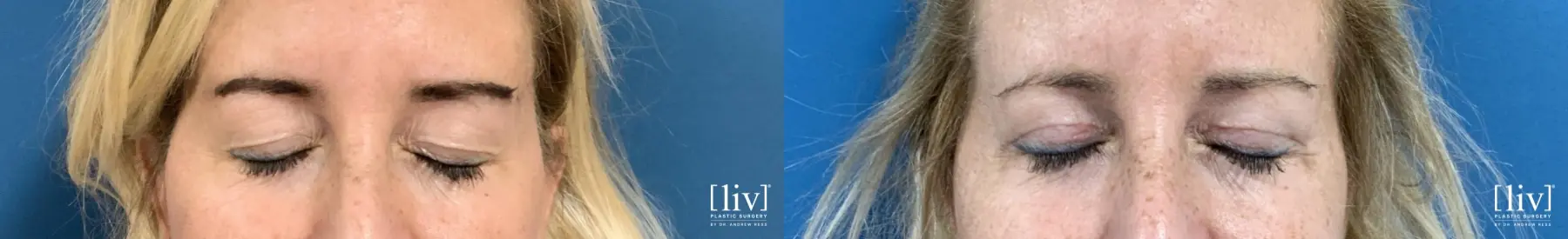 Upper Blepharoplasty - Before and After 4