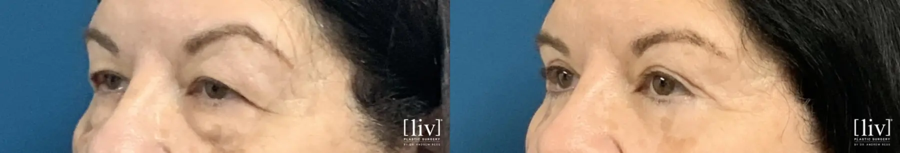 Upper and Lower Blepharoplasty  - Before and After 2