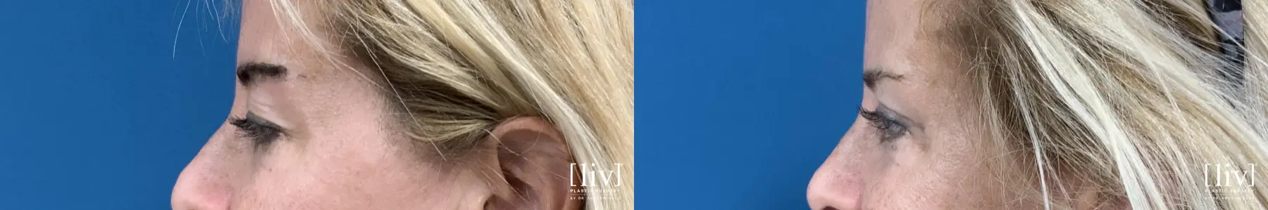 Upper Blepharoplasty - Before and After 3