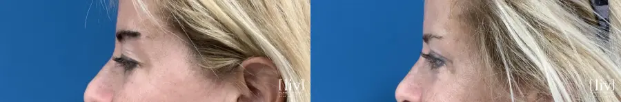 Upper Blepharoplasty - Before and After 3