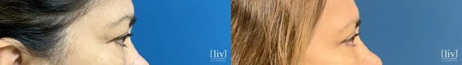 Upper Blepharoplasty - Before and After 2