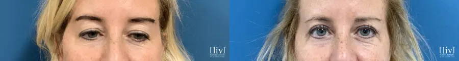 Upper Blepharoplasty - Before and After 1