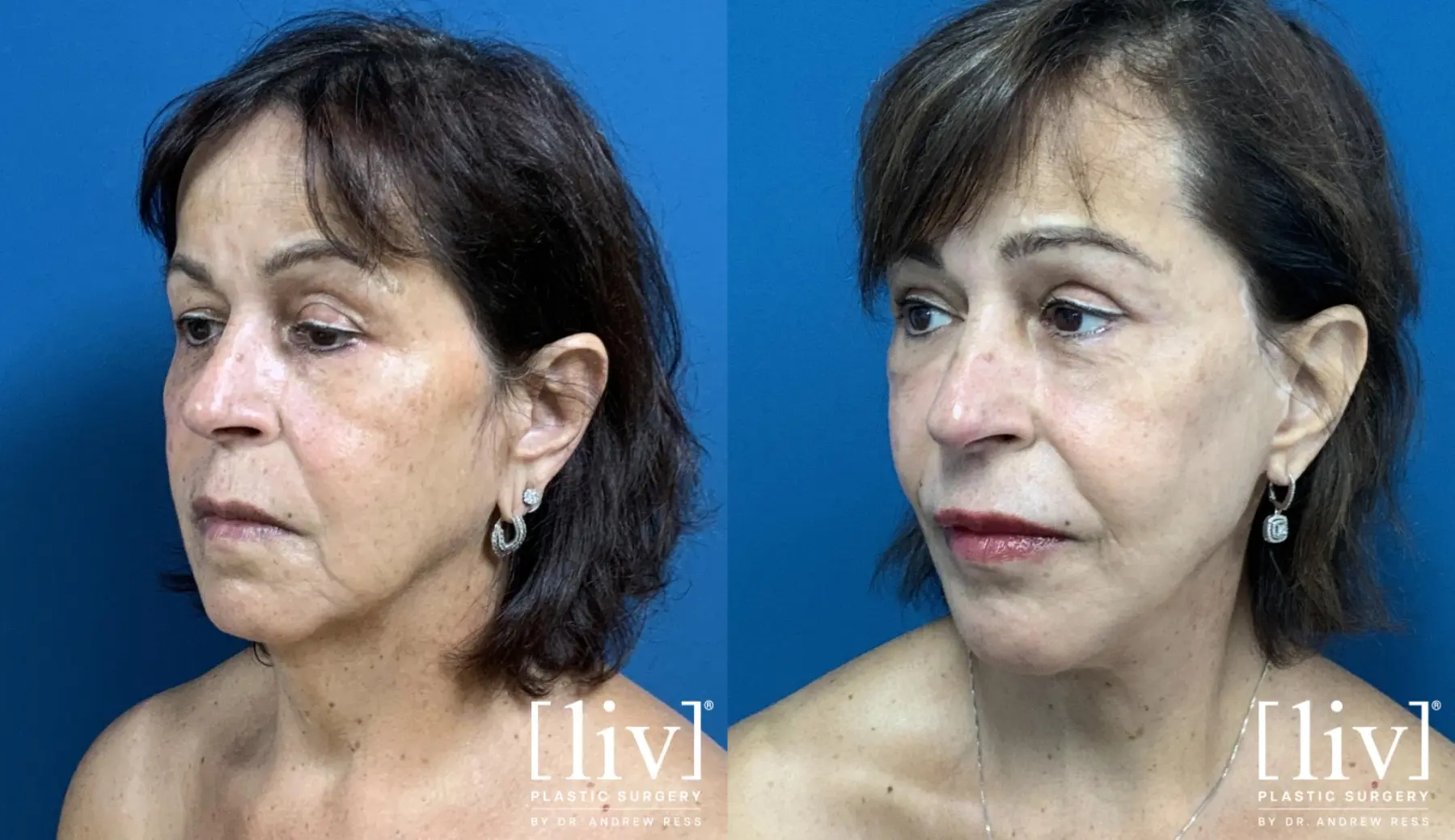 Upper Blepharoplasty - Before and After 2