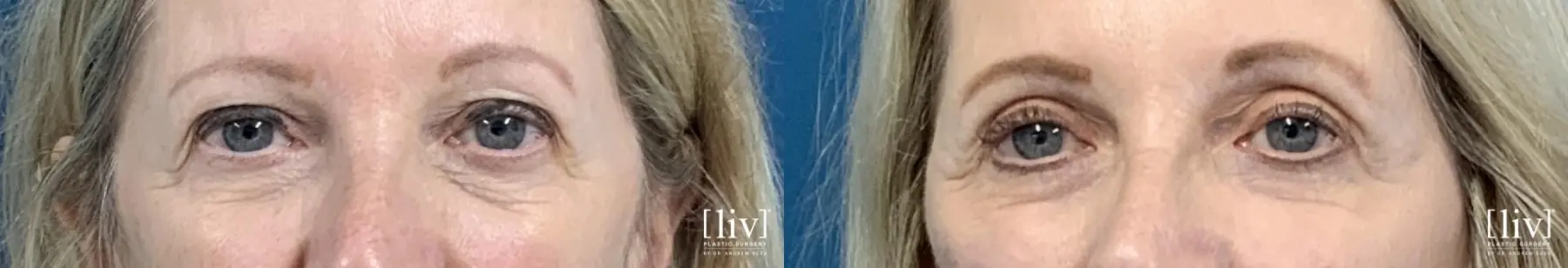 Upper Blepharoplasty - Before and After 1