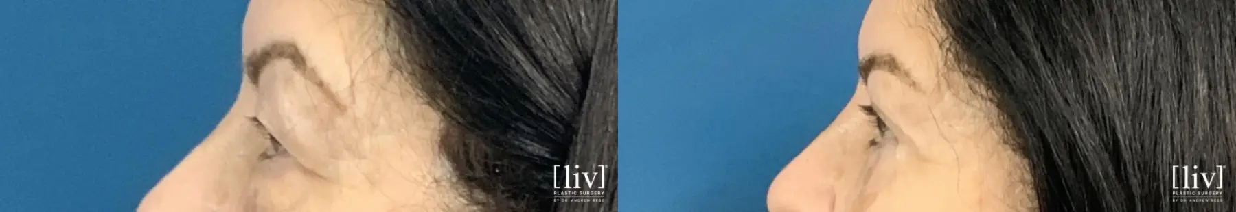 Upper and Lower Blepharoplasty  - Before and After 3