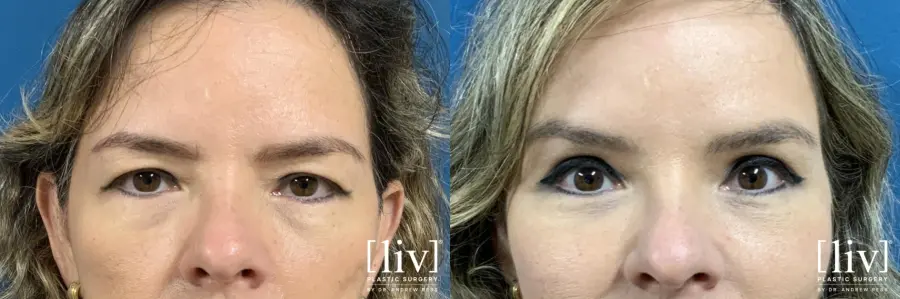 Upper Blepharoplasty - Before and After 1