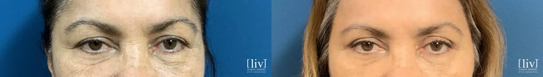 Upper Blepharoplasty - Before and After 1