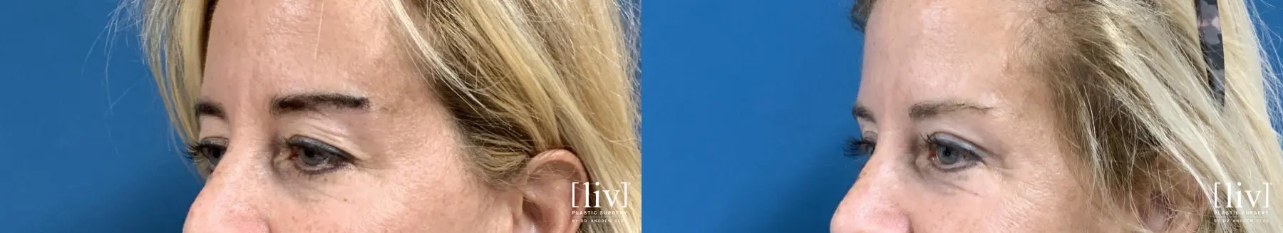 Upper Blepharoplasty - Before and After 2