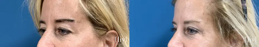 Upper Blepharoplasty - Before and After 2