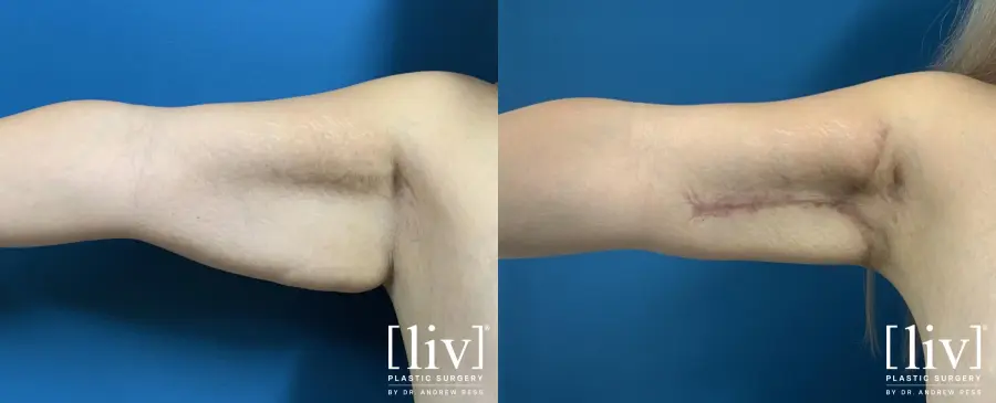 Brachioplasty with Liposuction - Before and After 1