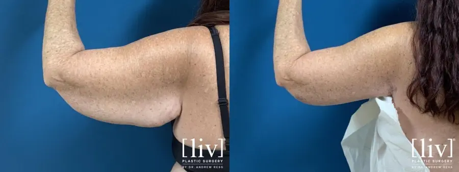 Brachioplasty: Patient 2 - Before and After 2