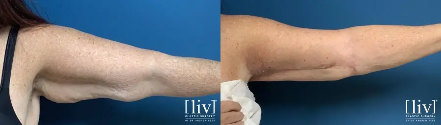 Brachioplasty: Patient 2 - Before and After 3
