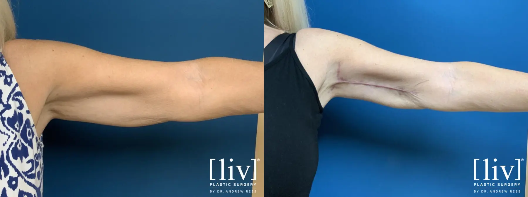 Brachioplasty - Before and After 1