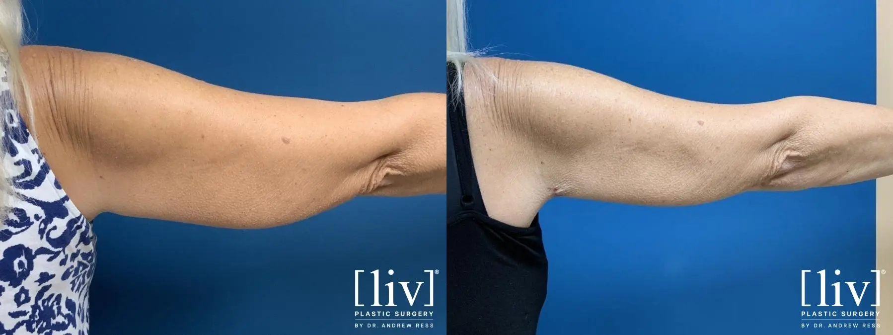 Brachioplasty - Before and After 2