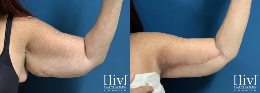Brachioplasty: Patient 2 - Before and After 4
