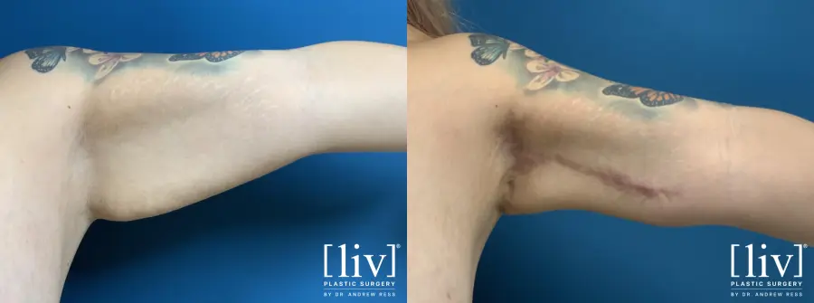 Brachioplasty with Liposuction - Before and After 2