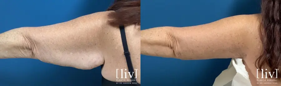 Brachioplasty: Patient 2 - Before and After 1