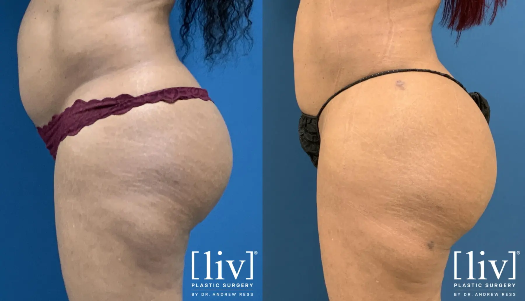 Brazilian Butt Lift: Patient 3 - Before and After 2