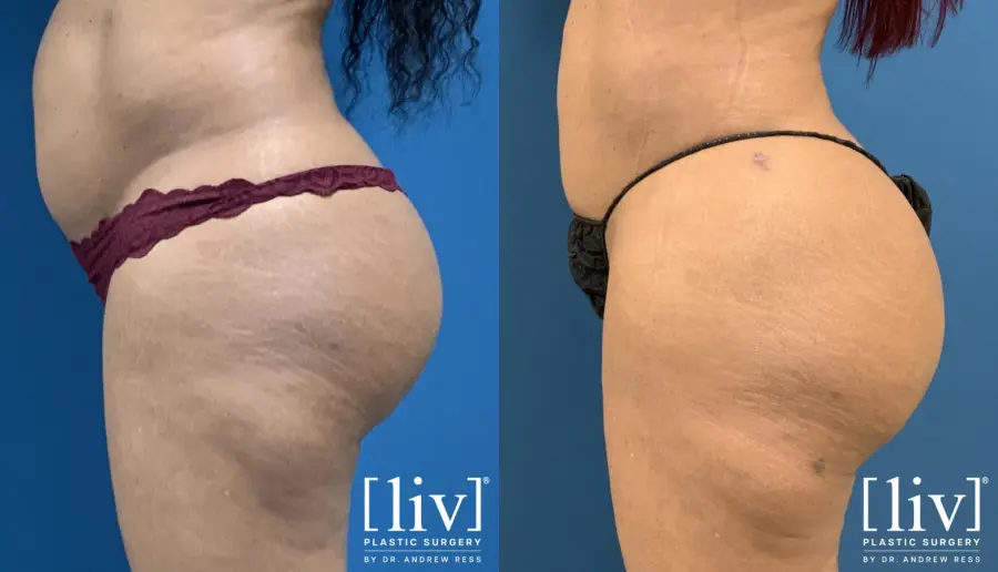 BBL with Liposuction - Before and After 2