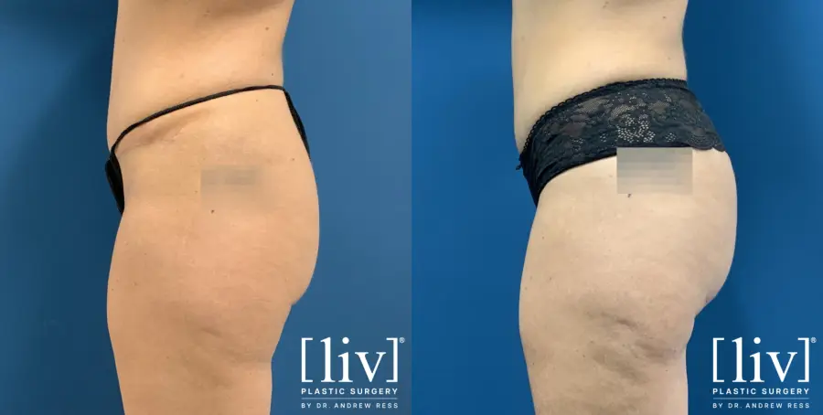 Brazilian Butt Lift: Patient 4 - Before and After 3