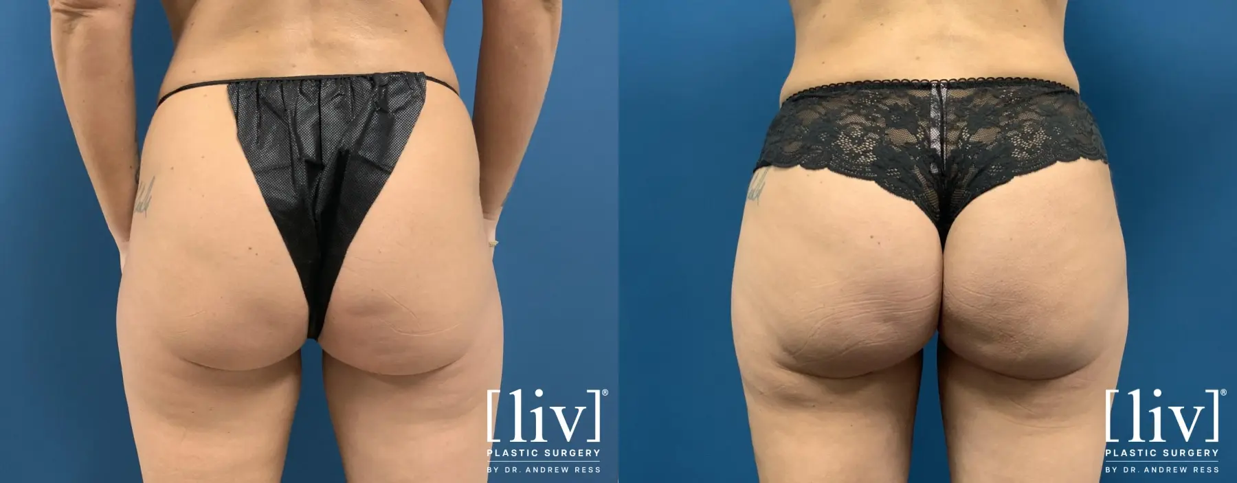Brazilian Butt Lift: Patient 4 - Before and After 1