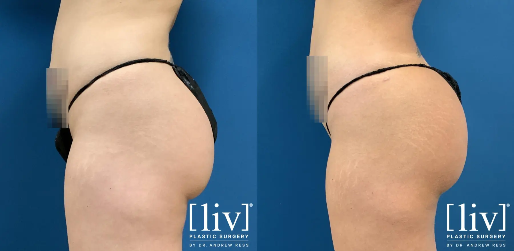 Brazilian Butt Lift: Patient 1 - Before and After 3