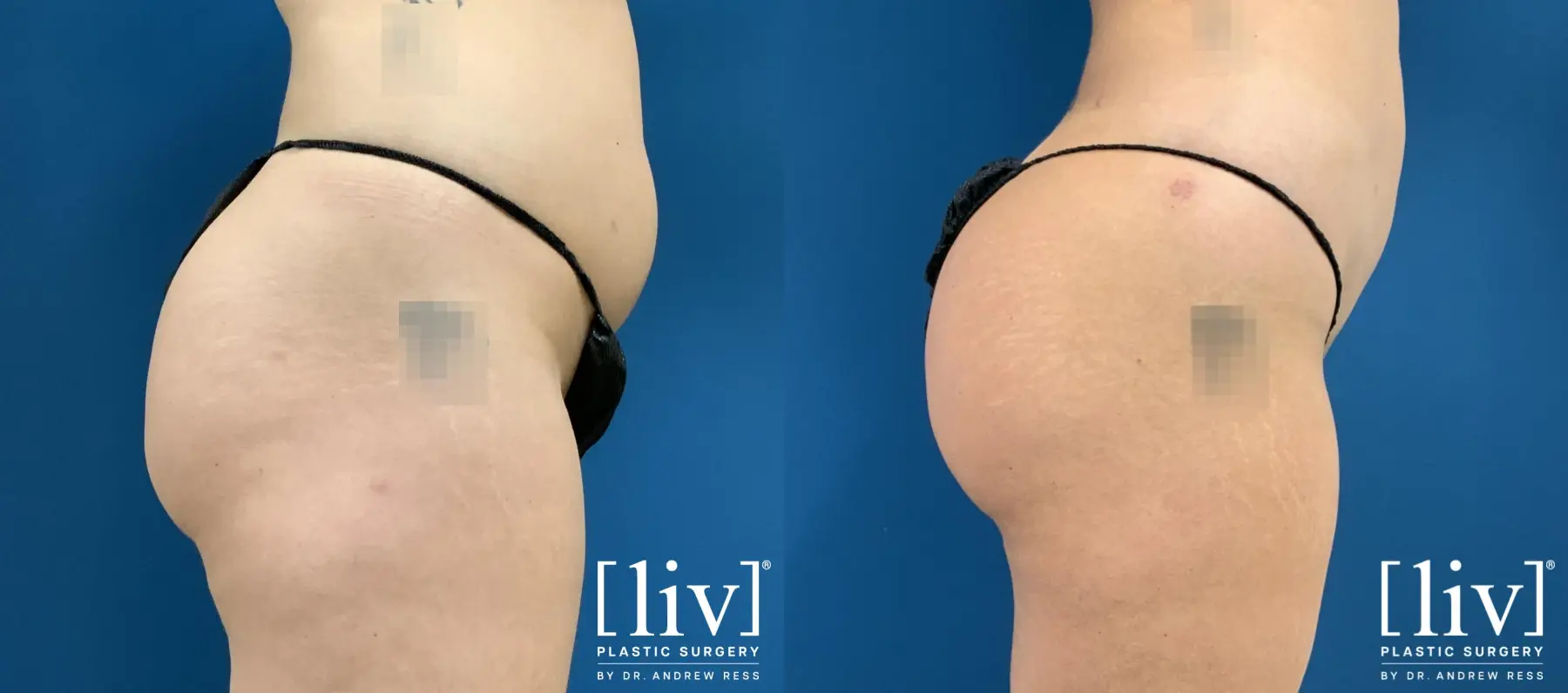 Brazilian Butt Lift: Patient 1 - Before and After 2