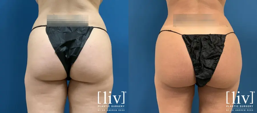 Brazilian Butt Lift: Patient 1 - Before and After 1