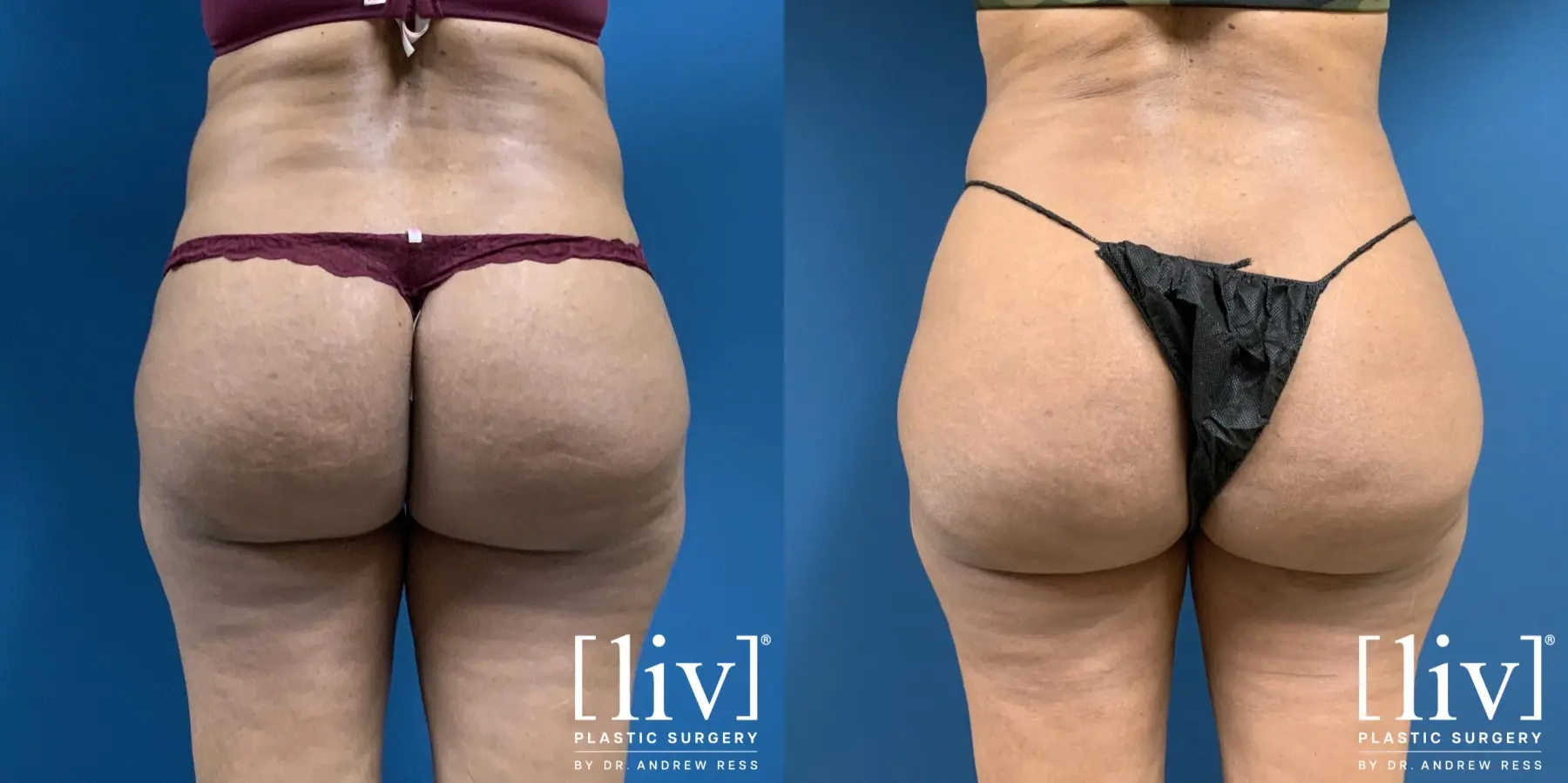 Brazilian Butt Lift: Patient 3 - Before and After 1