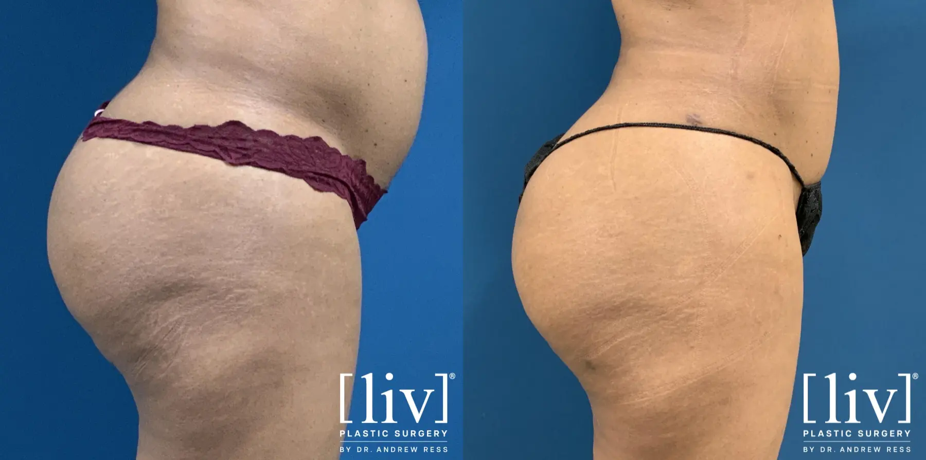 Brazilian Butt Lift: Patient 3 - Before and After 3