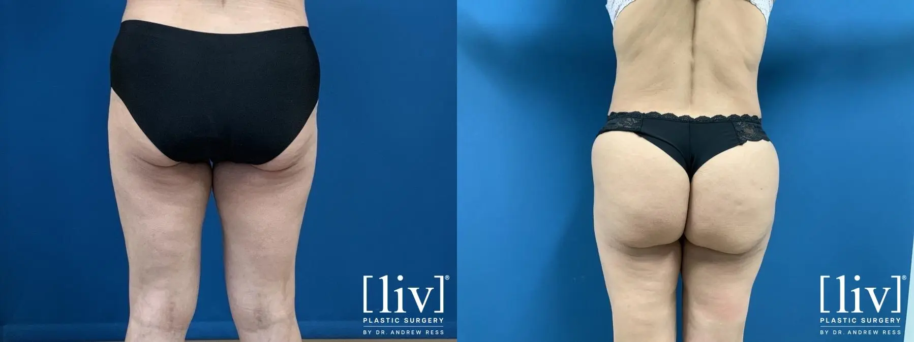 Brazilian Butt Lift: Patient 2 - Before and After 2