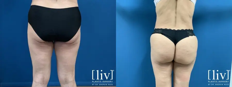 Brazilian Butt Lift: Patient 2 - Before and After 2