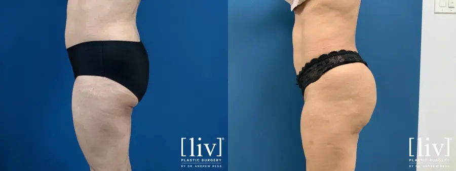 Brazilian Butt Lift: Patient 2 - Before and After 1