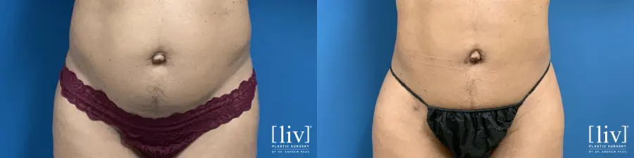 BBL with Liposuction - Before and After 4