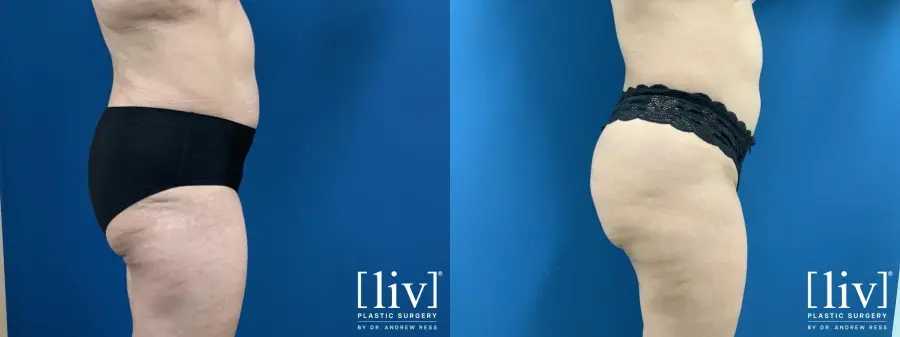 Brazilian Butt Lift: Patient 2 - Before and After 3