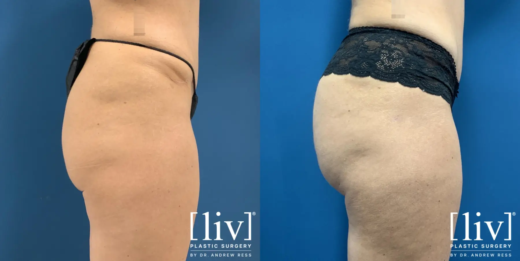 Brazilian Butt Lift: Patient 4 - Before and After 2
