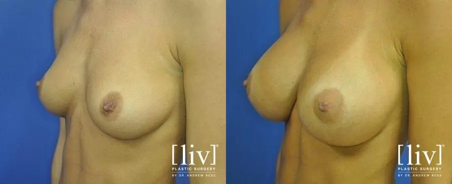 Breast Augmentation: Patient 11 - Before and After 4