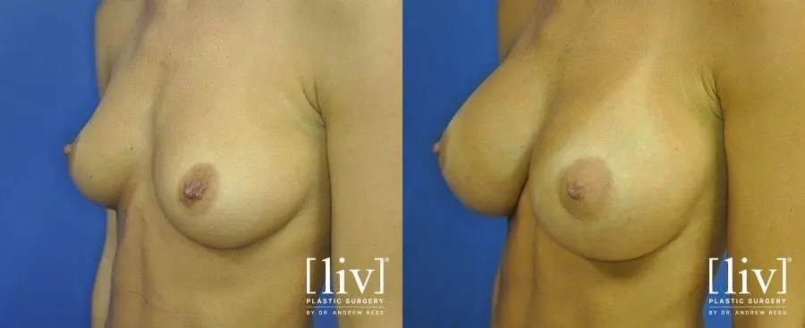 Breast Augmentation: Patient 10 - Before and After 4