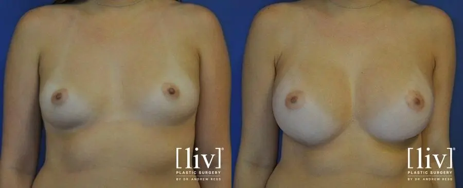 Breast Augmentation: Patient 7 - Before and After  