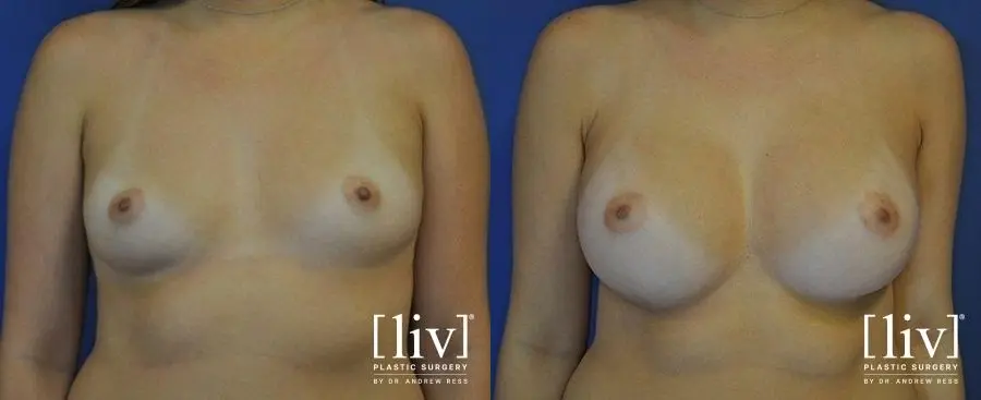 Breast Augmentation: Patient 7 - Before and After 1