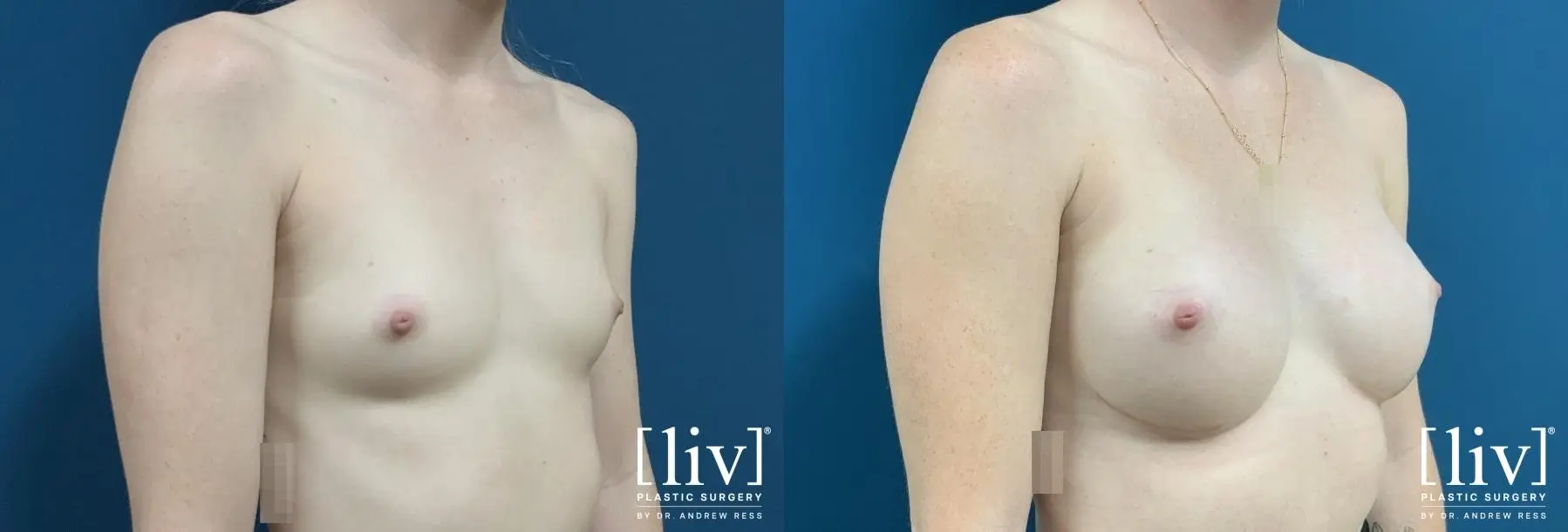 Breast Augmentation: Patient 4 - Before and After 4