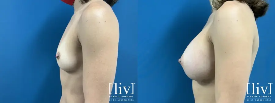 Breast Augmentation: Patient 1 - Before and After 3
